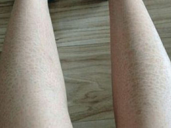 别不把鱼鳞病当回事，不治疗症状随年龄增长会更严重