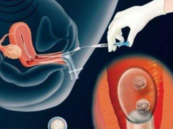 人工授精插管子真的很疼？可不可以忍受过来人告诉你答案