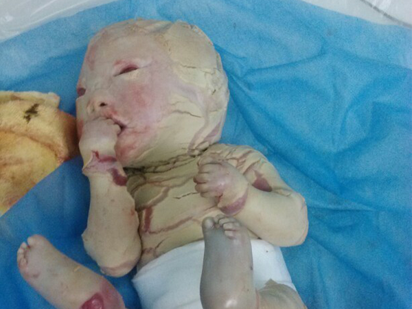 一组火棉胶婴儿长大后的图片火了，这些表现真让人心疼