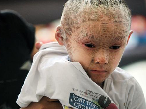 火棉胶婴儿治愈成难题，做好改善预防并发疾病成主流