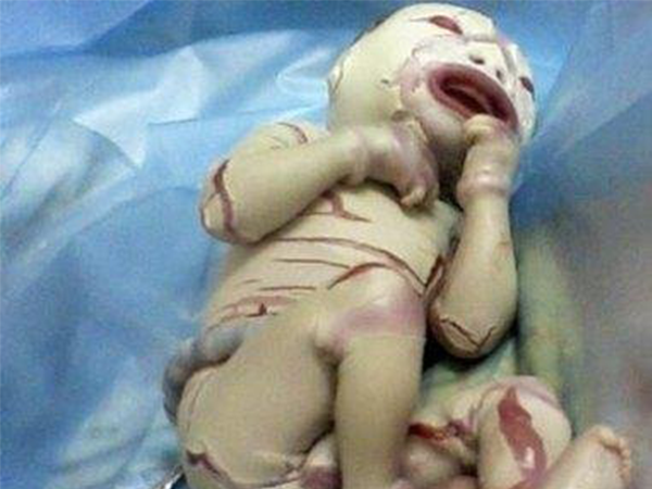 详解火棉胶婴儿的五大症状，皮肤褶皱形似塑料纸最直观