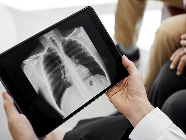 剖析小儿鸡胸的三大形成因素，家族遗传或是主因