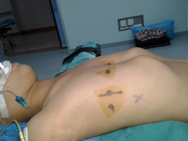 小儿鸡胸矫正时间别太晚，错过最佳时机后悔一生