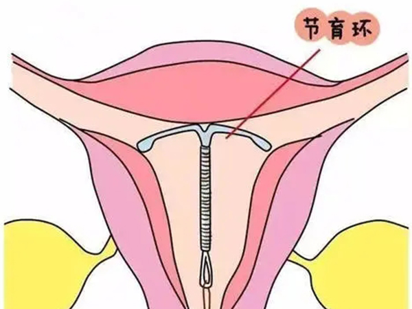 解读上节育环对女性身体的五大危害，损伤器官可不是小事