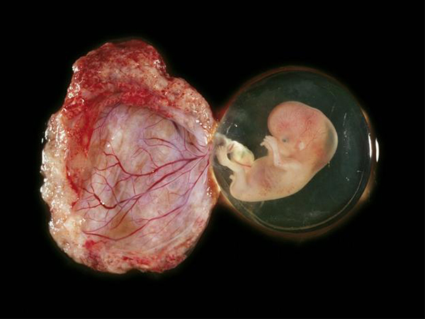 详述完全性前置胎盘剖腹产经历，大出血风险堪称“鬼门关”