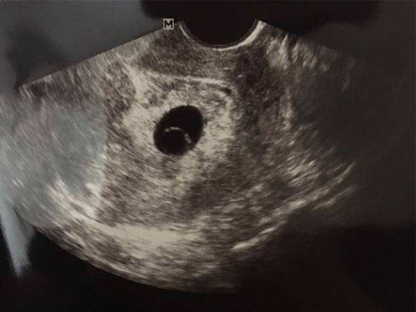 揭秘卵黄囊消失最佳时间，超过这个孕周数可能有问题