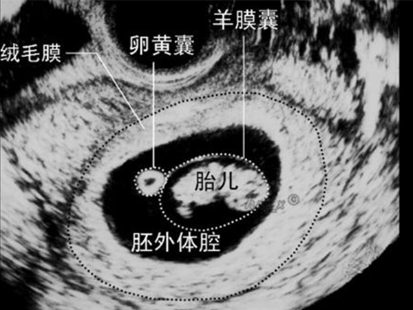 卵黄囊和怀孕天数详细对照表请收好，在不在正常范围一秒知
