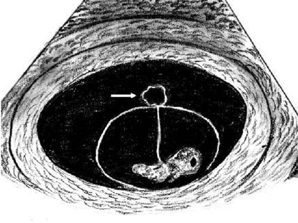 卵黄囊和孕囊可不是一个意思，除了出现顺序还有这些区别