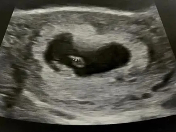 详解双胞胎卵黄囊出现时间，超过孕8周仍不可见一定不正常