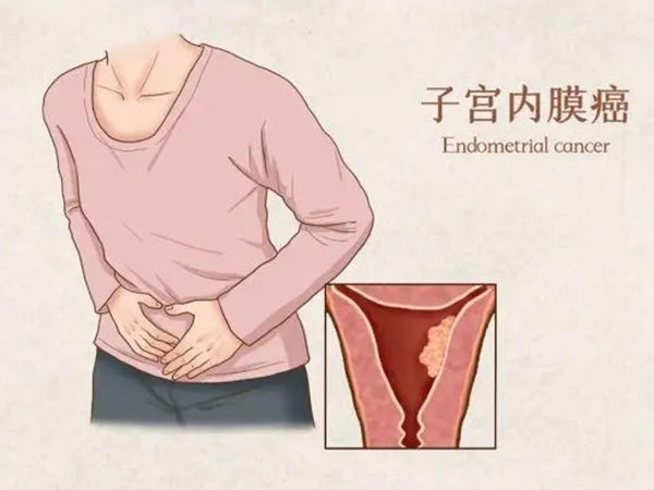 56岁绝经后再出血原因分析，内膜病变成最大可能