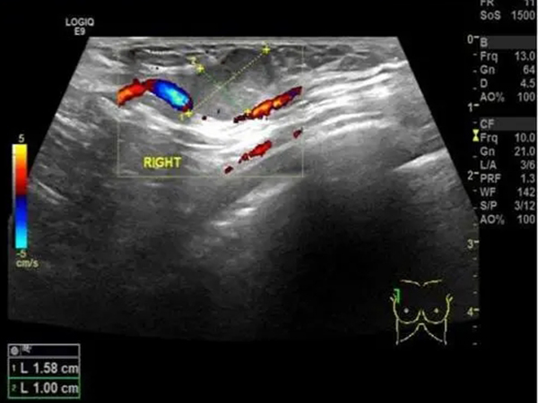 乳腺彩超全过程曝光，超声探头检查真的很简单