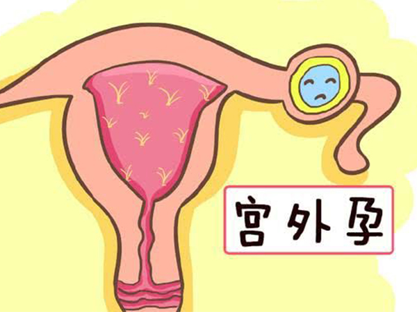 宫外孕初期症状很隐蔽，有不规则出血时切莫不在意