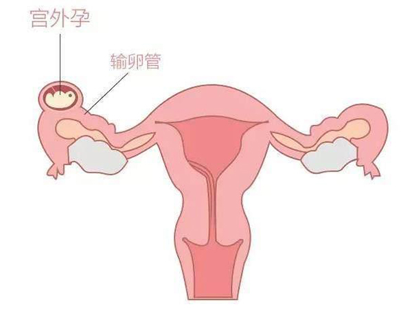 处理宫外孕得用对方法，想不影响身体健康就使这几招
