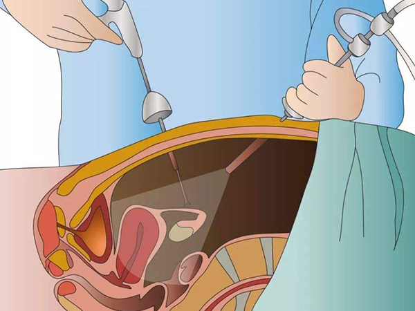 不知道绒穿疼还是羊穿疼？读懂二者操作步骤你就知道了