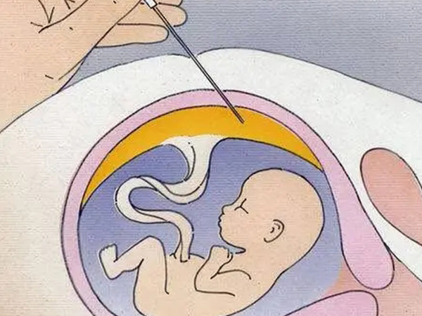 做毛绒穿刺的最佳时间有讲究，孕周数过早可能有风险