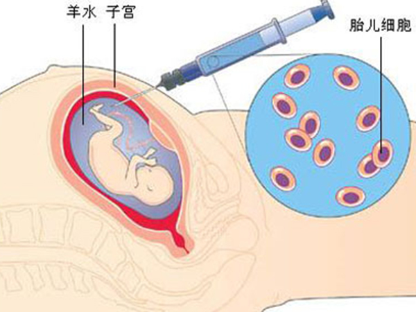 细数羊水穿刺两种检查项目明细，可不止能查羊水感染