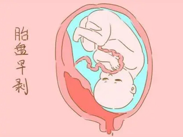 这四种人孕期很容易胎盘早剥，血管有问题的人群可得当心