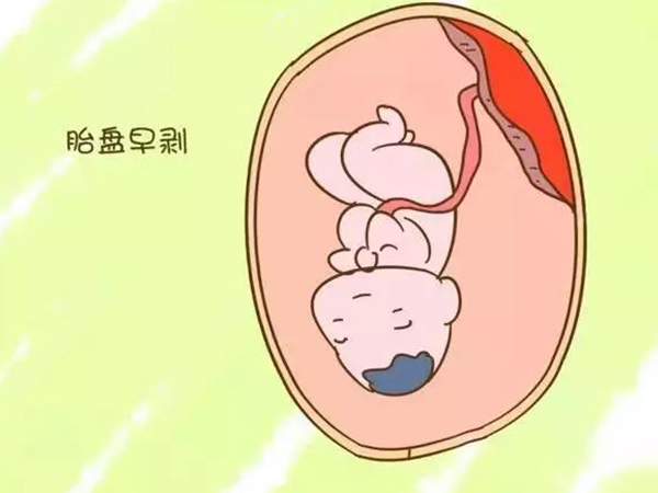 腹痛有这些特点时就是胎盘早剥，前壁+后壁有两种疼法