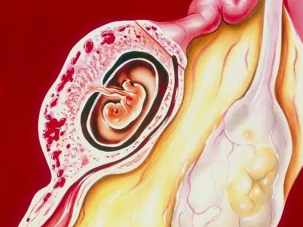 宫外怀孕时常表现出这些症状，这个位置疼时就要当心