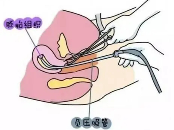 药流不全别急着清宫？醒醒吧，残留物引发感染后悔莫及！