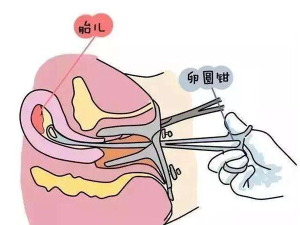 解读吃毓婷和人流对身体的伤害，哪个副作用更大一目了然