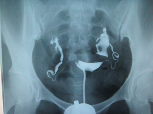 别跟风输卵管造影，不知道这些副作用前不要轻易做