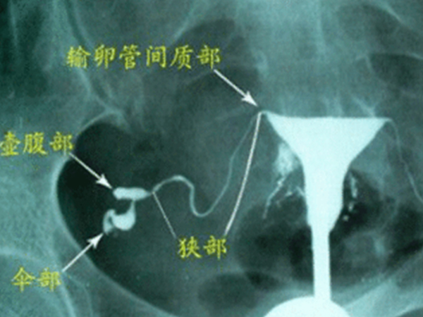 看懂输卵管造影片子只需一分钟，正常或异常影像表现不一样