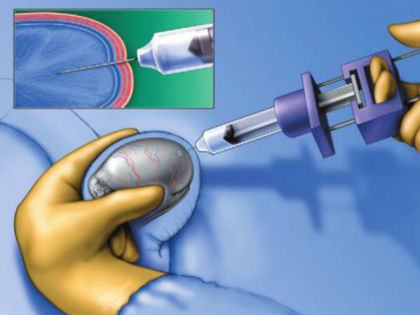 睾丸穿刺取精全过程解析，这六大步骤一个也不能少