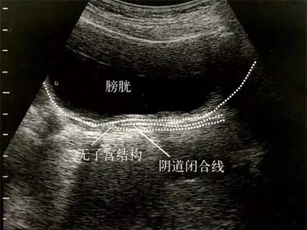 始基子宫超声诊断标准详解，看到无宫腔影像时得当心