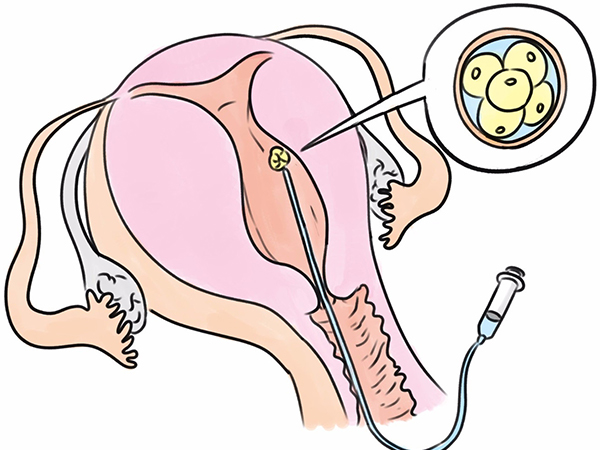 试管婴儿移植大揭秘，原来胚胎是这么放进子宫的
