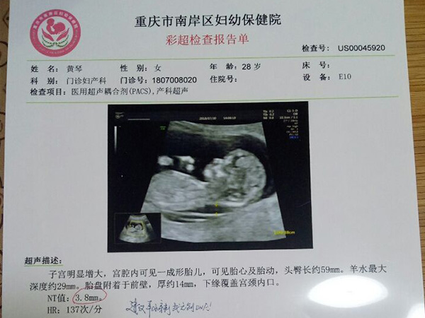 nt检查刺激胎儿翻身有方法，除了多走动还有这几招