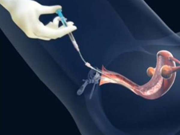 泰国试管移植后的五大注意事项，躺姿正确着床更轻松