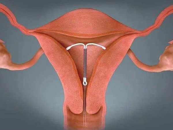 细数节育环下移至宫颈的危害，不止避孕失败那么简单