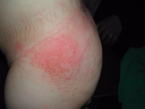 婴儿尿布疹护理有讲究，并非只有抹药才能好得快