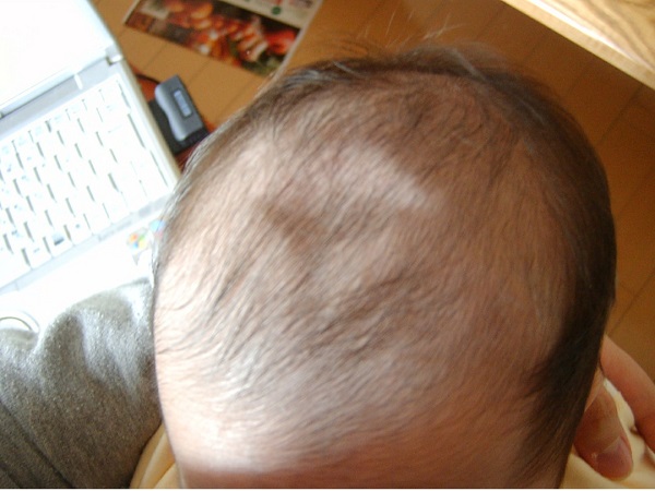 婴儿囟门闭合早的三大原因分析，钙质过多是关键因素