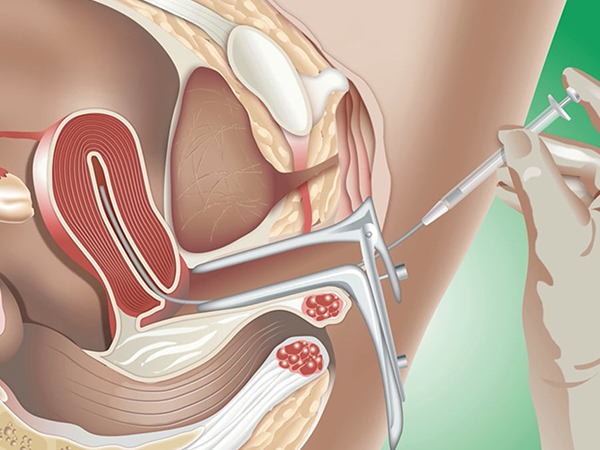 试管婴儿取卵手术全过程分享：疼不疼要看个人承受力