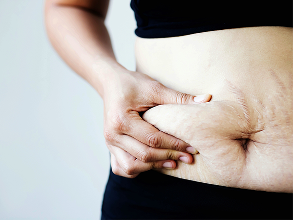 判断是不是妊娠纹得找对方法，通过裂纹颜色和部位帮你分辨