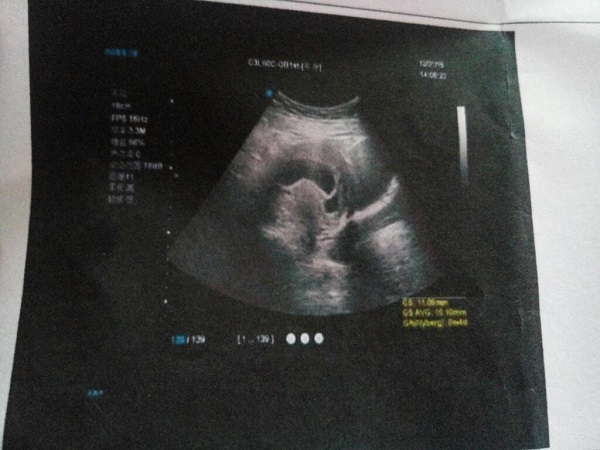 怀孕早期通过孕囊形状就能看男女，准不准看完你就知道了