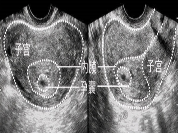 弄清孕囊圆形和椭圆形的区别，方知哪个发育得更好