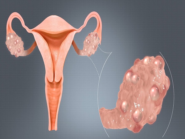 这几种人更容易得多囊卵巢综合征，精神压力大的人可得注意了