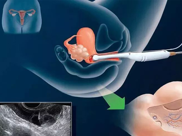 人工授精一次成功真实案例分享，做好这些准备工作成功率并不低