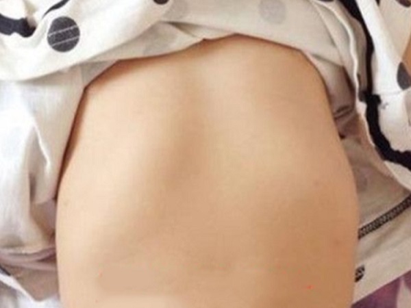 多图对比小儿鸡胸从轻度到重度变化，通过外观很容易判断