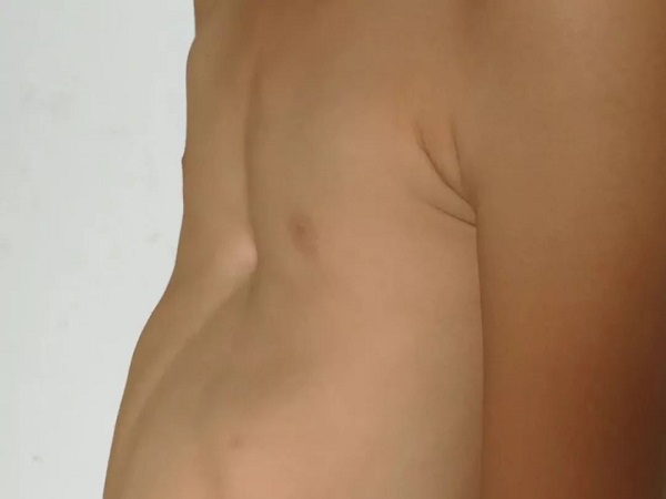 浅析造成小孩子漏斗胸的三大原因，家族遗传史千万别忽视