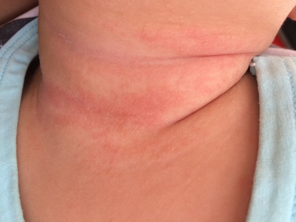 新生儿脖子起痱子不要急，除了用爽身粉这些妙招也能缓解