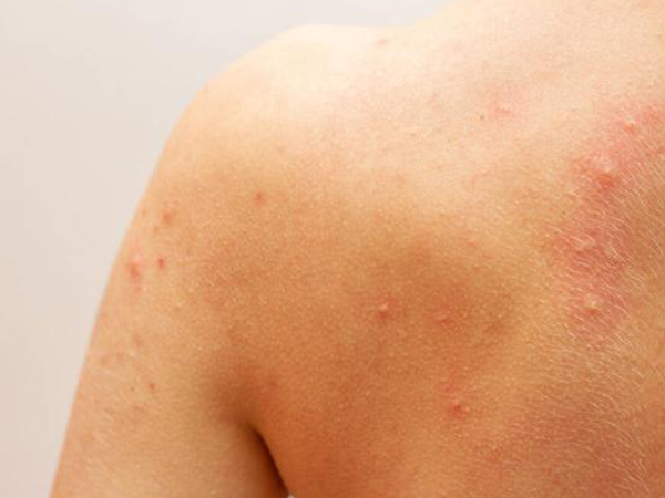 宝宝过敏与湿疹的区别图片分享，从症状和位置可准确区分