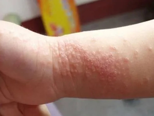 婴儿常见的五种湿疹类型图片分享，从症状就能够正确区分