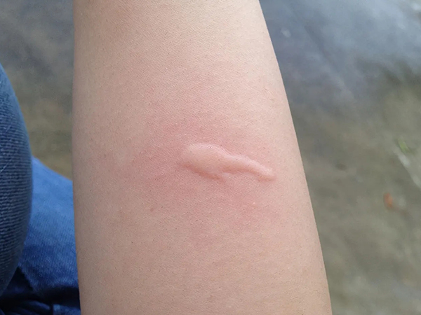 婴儿各种疹子的症状图片：助你轻松分辨宝宝身上的小红点