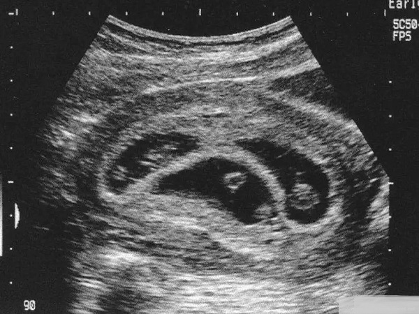 试管婴儿减胎的最佳时间有讲究，找准孕周可降低手术风险