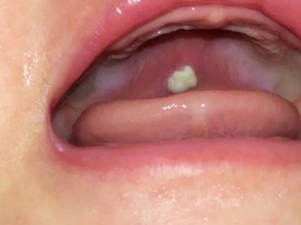 婴儿马牙和鹅口疮的区别图分享，从出现部位就能准确区分