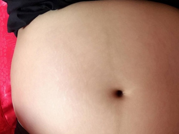 多图对比肥胖纹跟妊娠纹，颜色、分布位置有区别很好判断